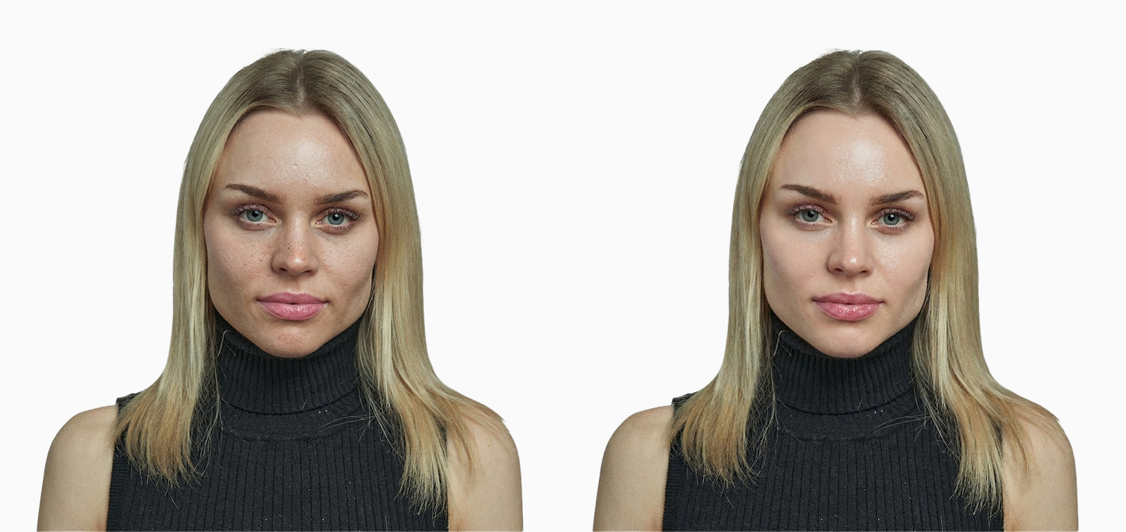 Dull skin texture before and after microdermabrasion exfoliation