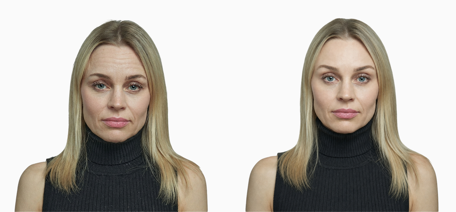 Heavy brow and forehead lines before and after endoscopic brow lift