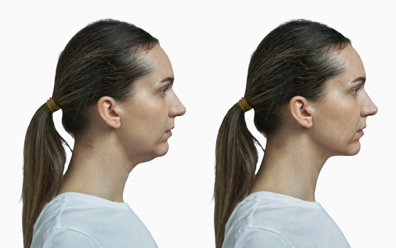 Submental fat pad before and after double chin surgery in profile
