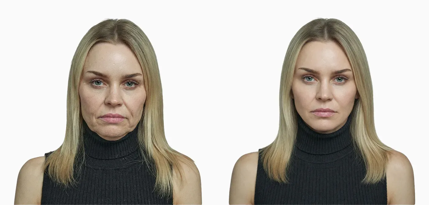 Jowls and midface descent before and after deep-plane facelift surgery