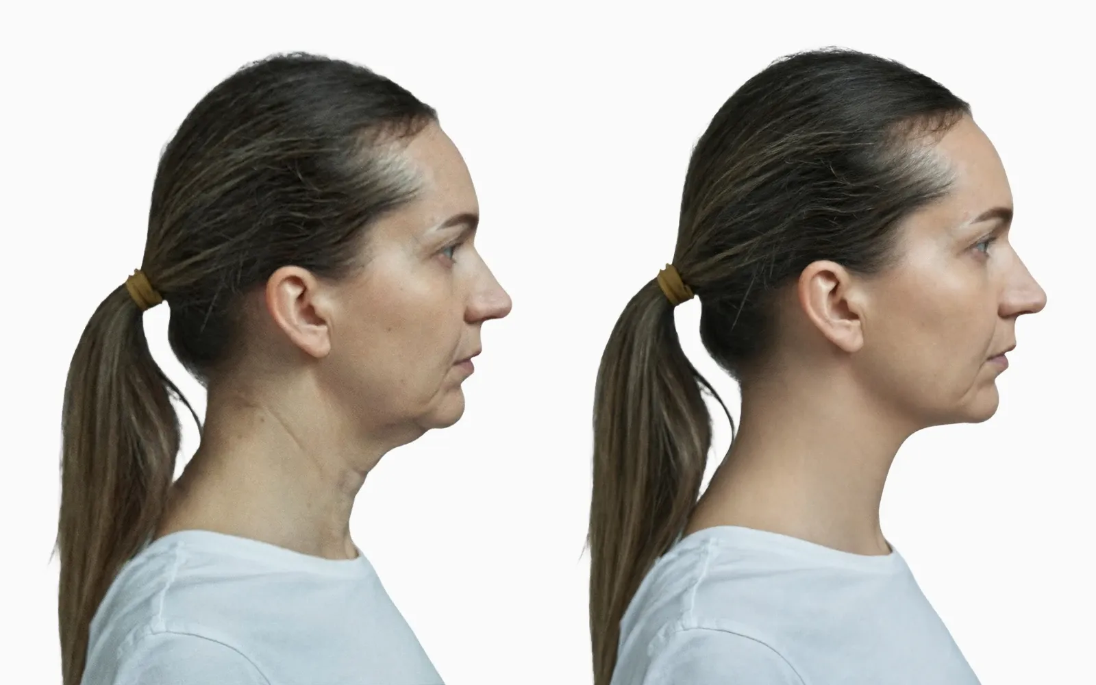 Submental fullness and obtuse cervicomental angle before and after neck lift in profile Submental fullness and obtuse cervicomental angle before and after neck lift in profile