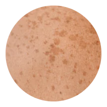 Close-up of skin with freckles